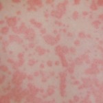 Summertime! Time For … Rashes Summertime! Time For … Rashes