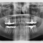 Are Routine Dental X-rays Dangerous?